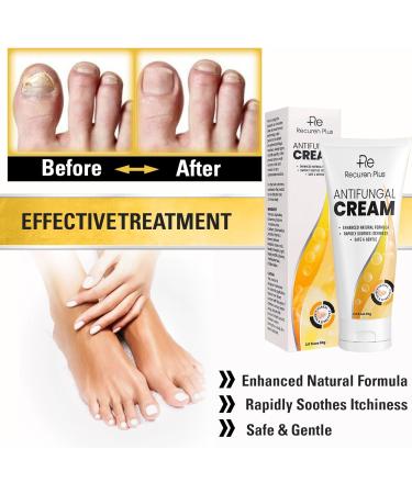 Antifungal Cream for Athletes Foot, Ringworm & Jock Itch - Anti Fungal Skin Treatment for Adults - Sensitive Skin Formula - Buy Online on GoSupps.com