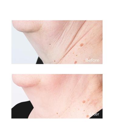 Cold Plasma Plus + Sub/D Chin & Neck | Revitalize & Tighten Skin | International Shipping Available - Buy Online on GoSupps.com