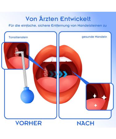 Abnaok Tonsil Stones Removal | Effective Tonsil Stone Remover & Tonsilclin Cupping Glass Fast International Shipping - Buy Online on GoSupps.com
