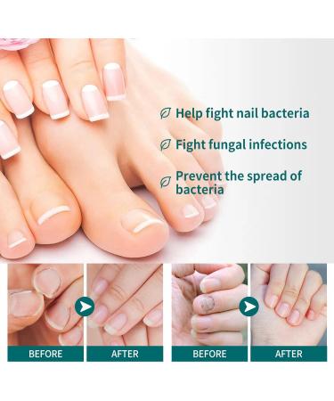 2 IN 1 Nail Fungus Treatment Oil - Fast Relief for Toenail Paronychia & Fungal Infections - Buy Online on GoSupps.com