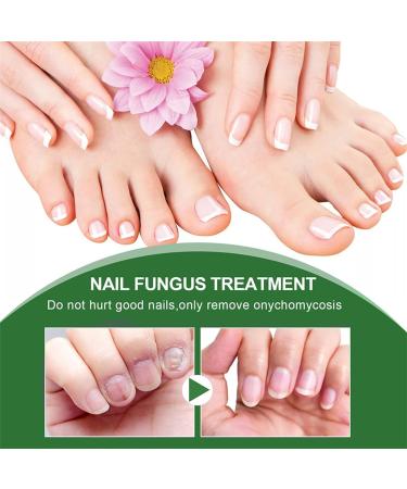 Fungal Nail Treatment - Extra Strong Nail Fungus Treatment for Toenail and Fingernail - Anti fungus Nail Repair and Strengthen Fix & Renew Damaged Broken Nails 1PC - Buy Online on GoSupps.com