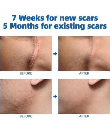 Scar Cream Gel for Face & Body - Effective Treatment for Surgical Scars, Stretch Marks, Acne, Keloids & Burns - 1.05 oz - Buy Online on GoSupps.com
