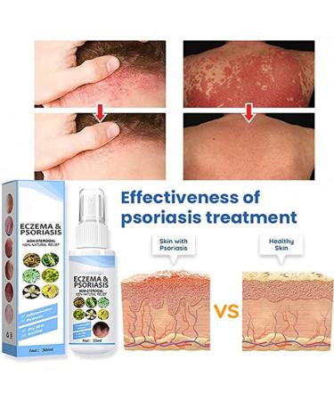 AKAZI Meellop Herbal Psoriasis Relief Spray 30ml - Soothe Dry Skin - 2 Pack - Buy Online on GoSupps.com