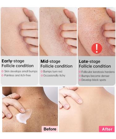 Keratosis Pilaris Cream Chicken Skin Care Cream Skin Exfoliating Repair Cream Keratosis Pilaris Treatment Legs Treatment Body Cream Rough Skin Cream For Rough And Bumpy Dry Skin 50g - Buy Online on GoSupps.com