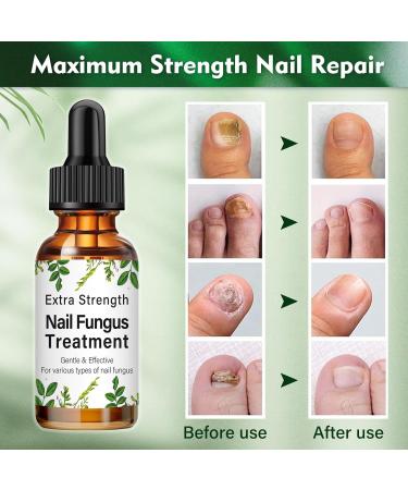 Fungal Nail Treatment 30ML - Extra Strong Solution for Toenails & Fingernails - Restores Healthy Nails - Protects Thick, Broken, and Discolored Nails - Green-1 - Buy Online on GoSupps.com