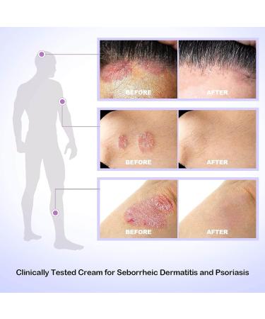 Dr. DERM Seborrheic Dermatitis Cream - Psoriasis Scalp Treatment for Folliculitis, Dry Scalp & Dandruff - Anti-Itch & Soothing Relief - 3.4 Fl Oz - Buy Online on GoSupps.com