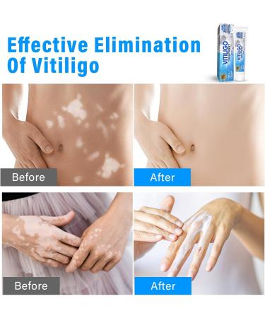 Effective Vitiligo Treatment Cream | Restore Skin Pigmentation & Reduce Fading - Buy Online on GoSupps.com