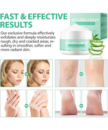 Urea Cream 40 Percent 2% Salicylic Acid Nourishes And Soothes Your Skin Moisturizes And Exfoliates Dead Skin For Dry And Cracked Heels Knees - Buy Online on GoSupps.com