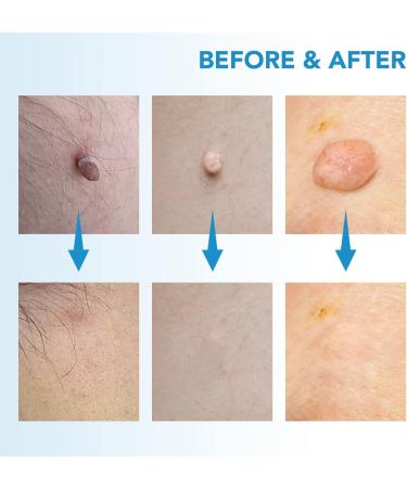 Skin Tags Treatment Nolisia Skin Tag Treatment Anti Skin Tags Skin Wart Removal Device 2-8mm 2 in 1 for Removing Face Body Warts - Buy Online on GoSupps.com