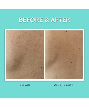 Bliss Clear Genius Body Acne Spray - Maximum Strength 2% Salicylic Acid - 3.5 oz | Clean, Cruelty-Free, Paraben Free, Vegan - Buy Online on GoSupps.com
