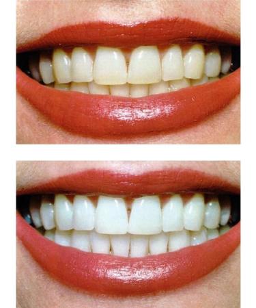 Teeth Whitening Kit Teeth Whitening Machine 2pcs Teeth Whitening Gel with Dental Tray - Buy Online on GoSupps.com