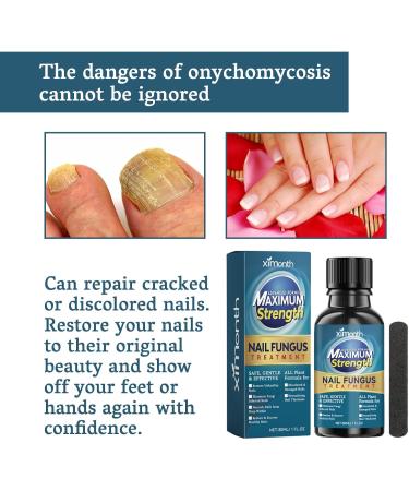 Fungal Nail Treatment - Extra Strong Nail Fungus Treatment for Toenail and Fingernail - Fungal Nail Eliminator Anti fungus Nail Repair and Strengthen Fix & Renew Damaged Broken Nails 30ml - Buy Online on GoSupps.com
