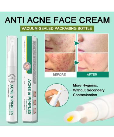 Anti Acne Face Cream & Dark Spot Remover for Face Acne Cream Spot Cream For Acne & Spot Anti Acne Spot For Face Back Inner Thigh Butt Blackhead Remover Cream for Face & Back Acne Anti-Blemish Care - Buy Online on GoSupps.com