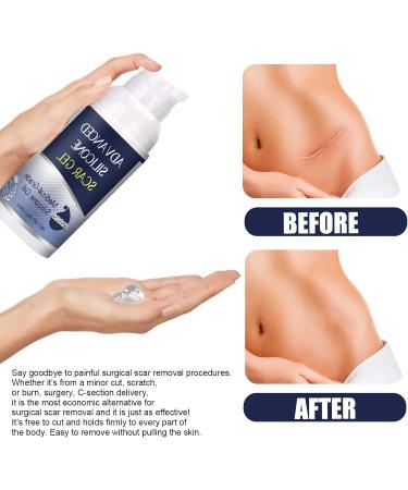 Scar Gel for Face Advanced Scar Remover Anti Scar Cream for Face Silicone Scar Gel Scar Cream Scar Removal Cream for Cesarean Burns and - Buy Online on GoSupps.com