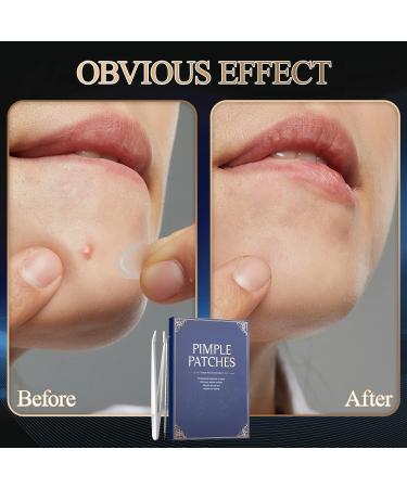 252 PCs Sugelary Pimple Patch 2-in-1 Invisible Hydrocolloid Pimple Patches | Effective Anti-Acne Solution (8mm & 12mm) - Fast International Shipping - Buy Online on GoSupps.com