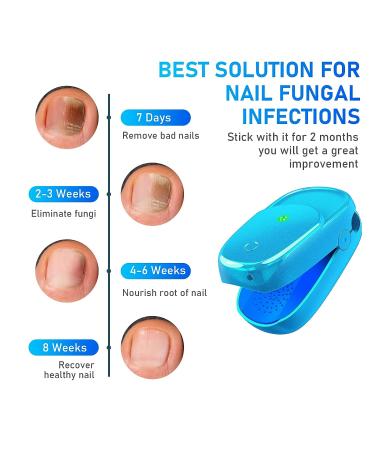 Nail Fungus Laser Treatment Device for Toenails and Fingernails - Home Use Blue Onychom Laser Cleaner for Effective Toenail Fungus Treatment - Buy Online on GoSupps.com