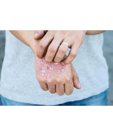 Prosoria Psoriasis Treatment Gel - 2oz Topical Relief for Dry, Itchy Skin - Reduces Scaling, Flaking, and Irritation - Buy Online on GoSupps.com