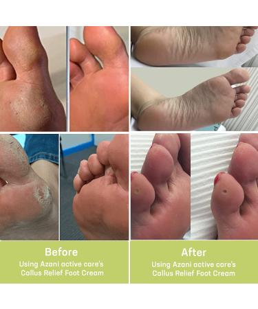 Azani Callus Relief Foot Cream - Intensive Exfoliator & Moisturizer with 25% Urea, Castor & Tea Tree Oil - for Callus, Corns, Cracked Feet & Hands - 3.5 Oz (100 gm) - Buy Online on GoSupps.com