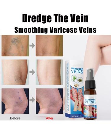 Xirujnfd Vein Healing Spray - Effective Varicose Veins Treatment for Legs | Improve Blood Circulation (1PCS) - Buy Online on GoSupps.com