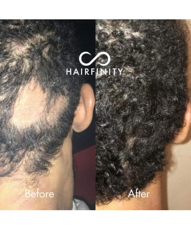 Hairfinity Infinite Edges Hair Serum - Hair Growth Treatment for Alopecia - Stimulates Hair Follicles, Prevents Hair Loss, and Promotes Regrowth - Sulfate & Silicone Free - Buy Online on GoSupps.com