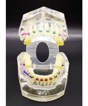 Dental Typodont Orthodontic Teeth Model with Metal Braces & Ligature Ties - Buy Online on GoSupps.com