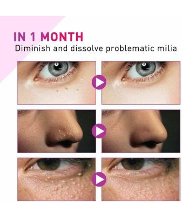 ZHBiwmatn 2024 New 4Pcs Milia Clearing Essence Milia Remover Eye Serum Milia Remover Milia Spot Treatment Miliary Repair Essence Moisturize Skin Improve Skin Texture for All Skin Types 30ml/1.8fl.oz - Buy Online on GoSupps.com