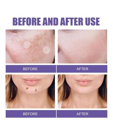 Hyperpigmentation Pflaster - 144 Invisible Dots for Fast Relief | Non-Irritating Spot Treatment - Buy Online on GoSupps.com