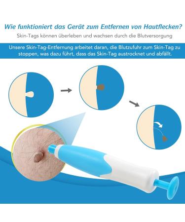 Skin Day Distant Car Skin Tag Remover Kit | Safe & Painless 2-in-1 Wart Removal | 20 Large & 20 Small Patches for 2-8 mm Tags - Buy Online on GoSupps.com