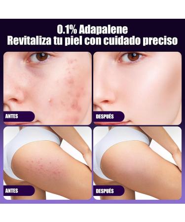  Generisch Anti-septic cream reduces impurities and regulates sebum production and refines pores for a pure complexion (3 pieces 20 g) - Buy Online on GoSupps.com