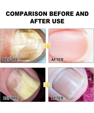 SenhE Fungus Laser Therapy Device Antibacterial Laser Equipment Light Therapy Device Fungal Nail Revolutionary High-Efficiency Light Therapy Device for Toenail Diseases  - Buy Online on GoSupps.com