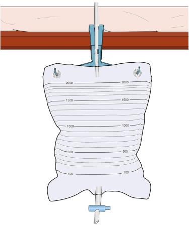 E&E Catheter Bag Hanger - Plastic Stand for Urine Drainage Bag - 2L Capacity (Pack of 10) - Buy Online on GoSupps.com