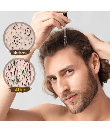 Minoxidil 5% Hair Growth Kit with Derma Roller and Serum - Men & Women Hair Loss Solution - Buy Online on GoSupps.com