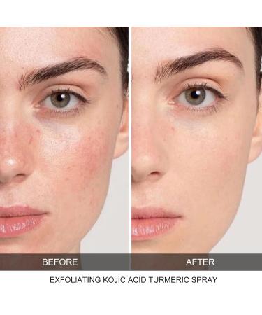 CHZHEN Keratin Care Kojic Acid Turmeric Spray - Exfoliating Body Spray for Face and Body - Gentle Brightening Treatment for All Skin Types (1) - Buy Online on GoSupps.com