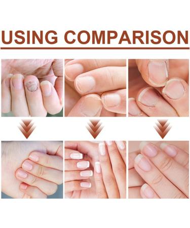 (My Favorites) KYOSK 5PCS 7 Days Nail Growth and Strengthening Serum Nail Serum Repair Essence Nail Growth & Strength Serum Toenail Nail For Repairing Damaged And Discolored Nails - Buy Online on GoSupps.com