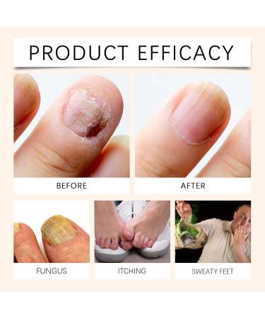 Bee Venom Nail Fungus Soothing Spray - Extra Strength Toenail Treatment (20ml) | Natural Nail Fungus Relief - Buy Online on GoSupps.com