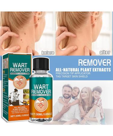 30ml Skin Remover Fast-Acting Skin Remover for Hands and Body Fall Away Quickly Natural & Safe Remover - Buy Online on GoSupps.com
