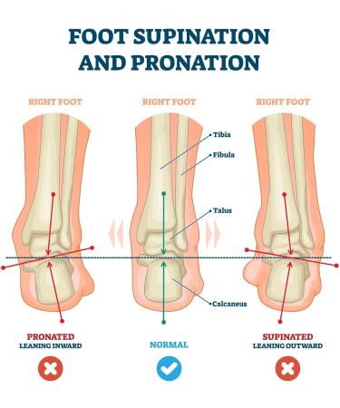 Pedag Correct German Made Medial & Lateral Wedge Heel Insert for Pronation & Supination - Corrects Knock Knee, Bow Legs - Veg Tanned Leather - Medium Size - Buy Online on GoSupps.com