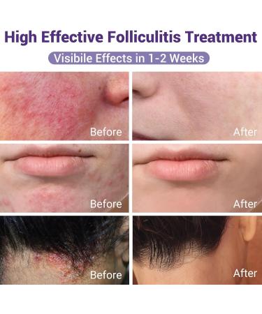 ishancare Folliculitis Treatment Highly Effective Folliculitis Cream Natural folliculitis for Itching Redness Inflammation Ache Burning 3.53 Oz 100g - Buy Online on GoSupps.com