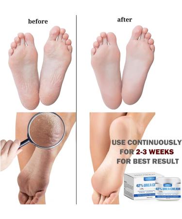 Urea 42% Foot Cream for Cracked Heel Repair & Callus Remover - 100g - Original + Lavender Scent - Maximum Strength for Dry & Hard Skin - Hand, Foot & Body Care - Buy Online on GoSupps.com