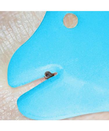 MYDAISY Tick Card with Magnifying Glass Ideal Tick Remover for Outdoor Activities Blue Ship Internationally - Buy Online on GoSupps.com