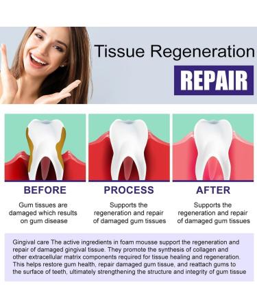 EXQST Gum Treatment Foam Gum Tissue Regeneration and Repair Deep Stain Cleaning Gum Treatment Foam Deeply Cleaning Gums Stain Removal Deep Stain Cleaning Gum Treatment Foam 1pcs - Buy Online on GoSupps.com