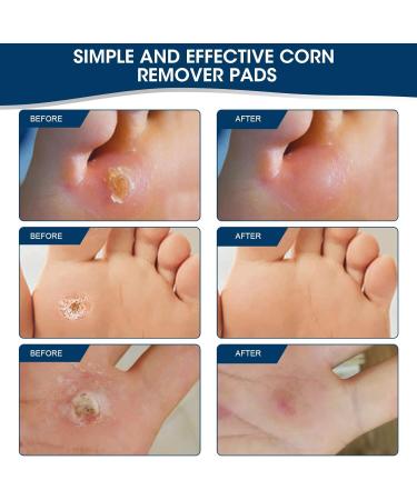 Mymulike 24 Count Chicken Pots - Effective Foot Care for Chicken Eyes & Corn Removal - Buy Online on GoSupps.com