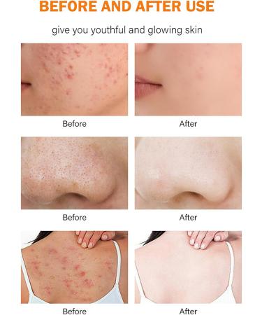 Kojic Acid & Turmeric Soap - Dark Spot Remover Brightening Soap - Turmeric Soap Bar for Acne Dark Spots Blackheads - Kojic Acid Soap for Face and Body - Buy Online on GoSupps.com