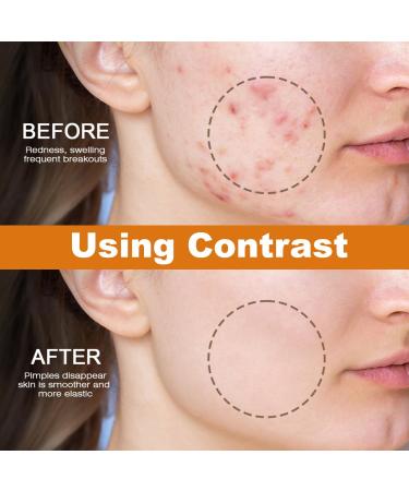 RedOceansM Acne grease and acne cream antipimple gel 20 g acne cream suitable for most skin types - Buy Online on GoSupps.com