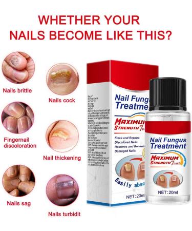 Extra Strong Fungal Nail Treatment 20ml - Premium Toenail and Fingernail Fungus Eliminator - Anti-Fungal Repair and Strengthening - 1 PCS - Buy Online on GoSupps.com