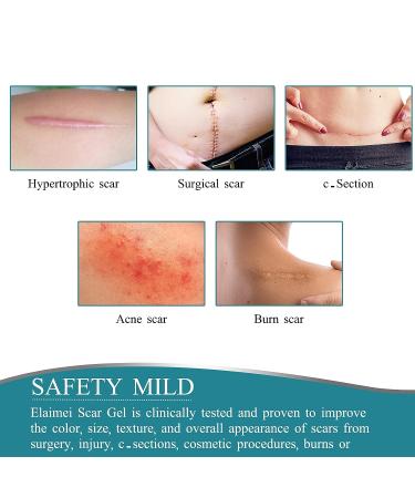 Silicone Scar Tape 1.6 x 60 Inch - Medical Grade Treatment for Surgery, C-Section, Keloid & Burn Scars - Safe & Painless Removal Strips - Buy Online on GoSupps.com