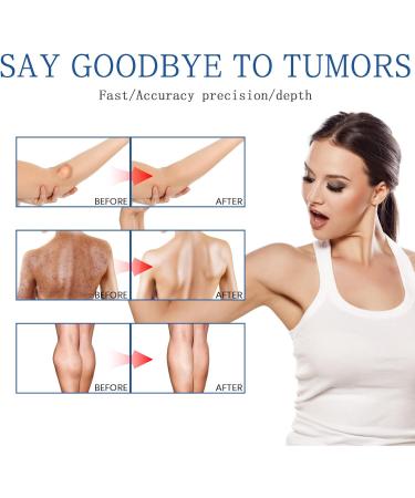 Lipoma Removal Spray Lipoma Reduction Anti-cellulite Body Shaper Spray for Men and Women 50ml - Buy Online on GoSupps.com