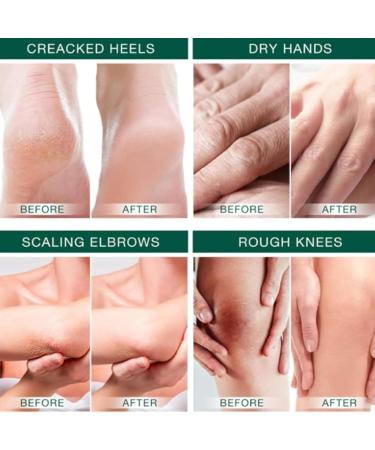 Urea 42% Foot Cream Urea Cream 40 Percent for Feet Urea Foot Cream Foot Cream for Cracked Heels and Dry Skin - Cracked Heel Repair Cream Foot Moisturiser Strength for Hand Foot and Body Care - Buy Online on GoSupps.com