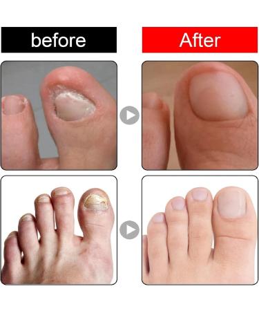 Ingrown Toenail Treatment and Removal Relief Oil - Nail Growth and Fungal Corrector - Buy Online on GoSupps.com