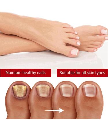 Fungal Nail Treatment Cream Antifungal Nail Polish Cream Nail Fungus Treatment for Toenail Strong Anti-Fungal Toenail Cream Nail Improve Cream Nail Repair Cream for Thick Cracked Discolored Nails - Buy Online on GoSupps.com
